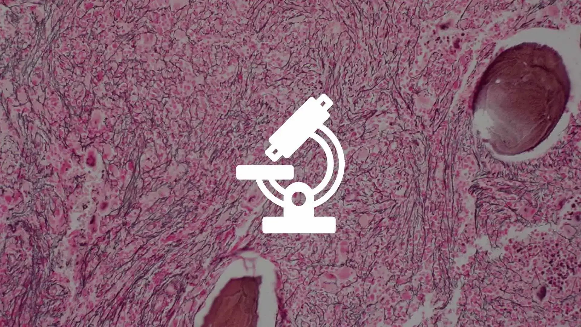 Myelofibrosis: The Fundamentals